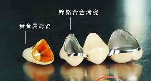 种植牙与烤瓷牙哪个比较好？