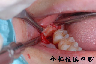 合肥拔智齿一颗多少钱？