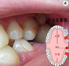 智齿开始发炎该怎么办？