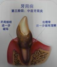 牙齿疾病该如何自我检测？