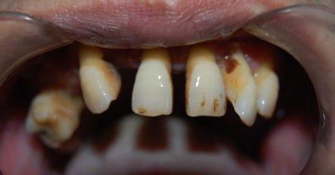 牙齿疾病发病的征兆有哪些？