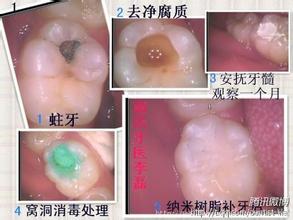 牙齿缺损时为什么要进行补牙？