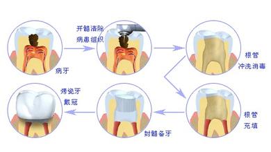 做根管的治疗需要多少钱？