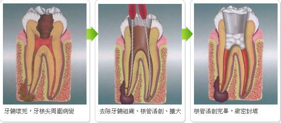 补一颗牙的价格是多少？