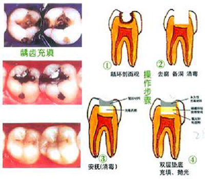 补牙的过程是怎么样的？