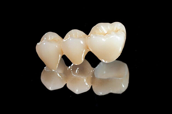 全瓷牙的寿命是多久？