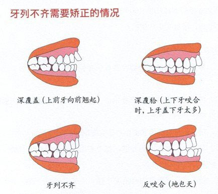 合肥牙齿矫正哪家好？