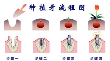 种植牙修复过程是什么？