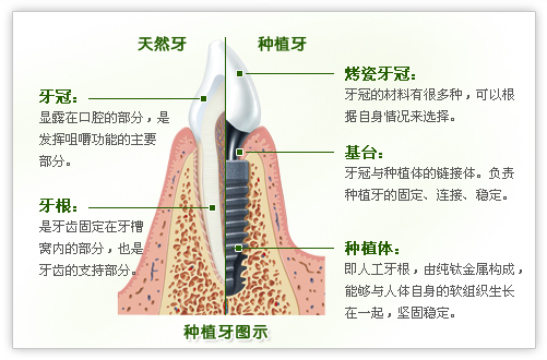 种植牙需要哪些条件？
