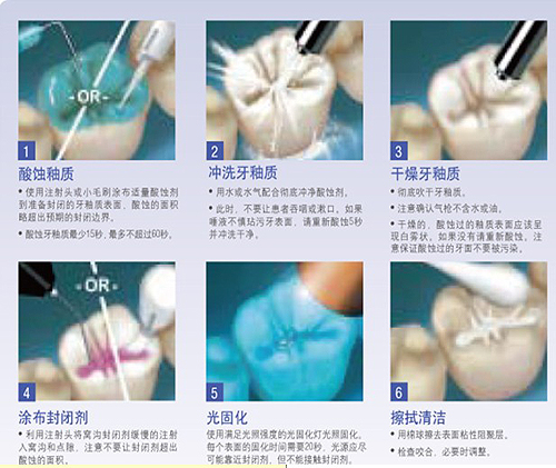 免费窝沟封闭——送给孩子较好的礼物
