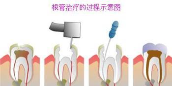 牙髓发炎需要做根管的治疗吗