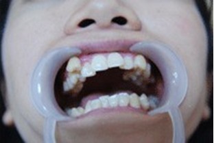 小孩牙颌面畸形怎么办？矫正