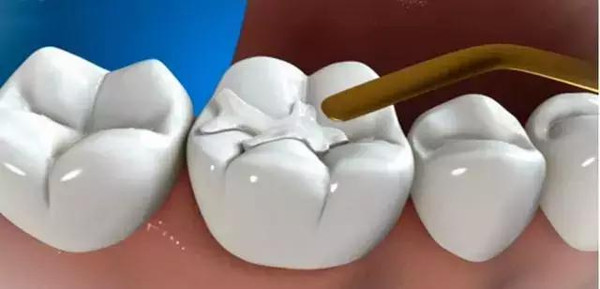 合肥一般补牙需要多少钱？